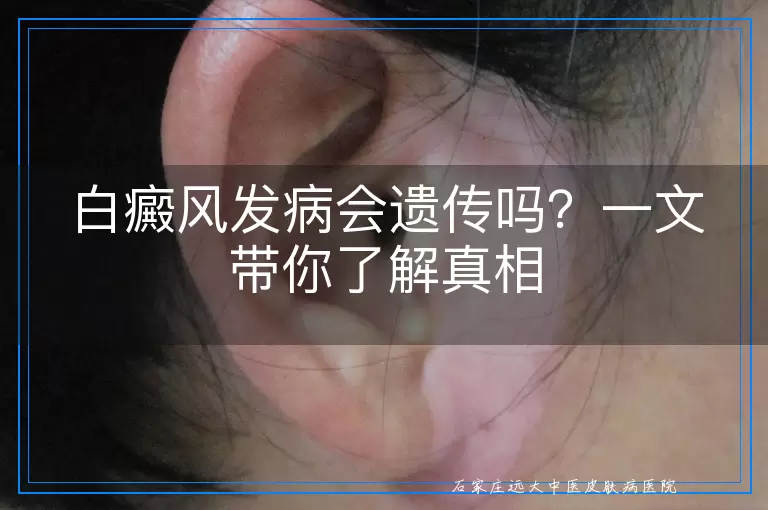 白癜风发病会遗传吗？一文带你了解真相