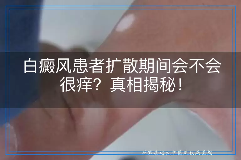 白癜风患者扩散期间会不会很痒？真相揭秘！