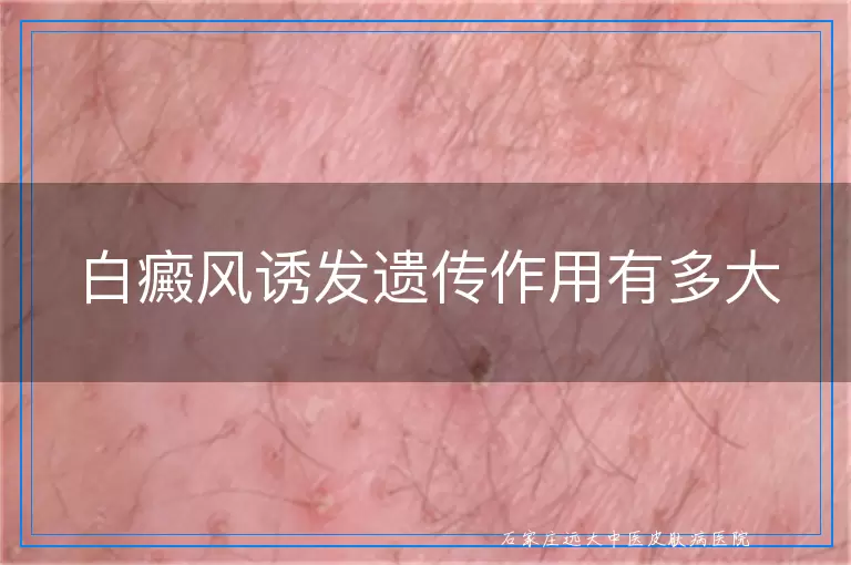 白癜风诱发遗传作用有多大