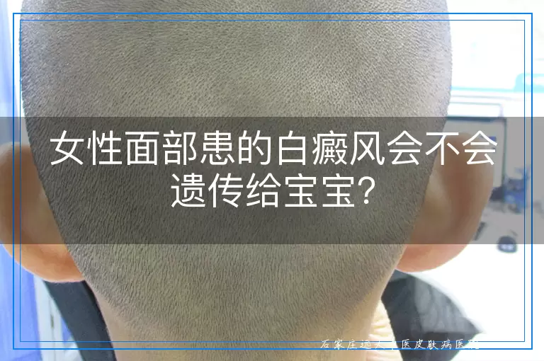 女性面部患的白癜风会不会遗传给宝宝？