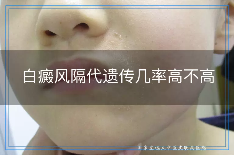 白癜风隔代遗传几率高不高