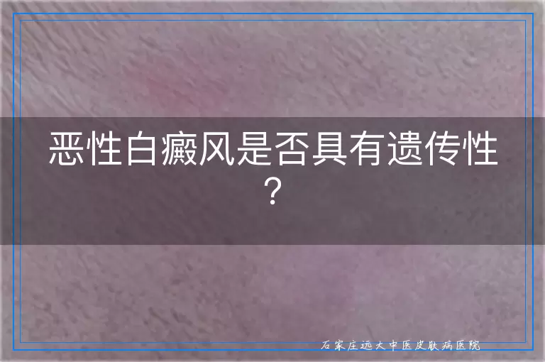 恶性白癜风是否具有遗传性？