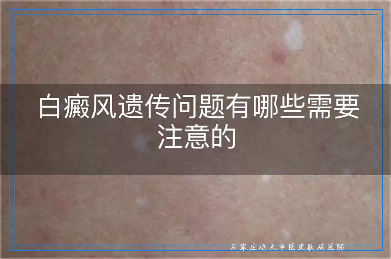 白癜风遗传问题有哪些需要注意的