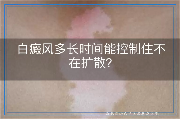白癜风多长时间能控制住不在扩散？