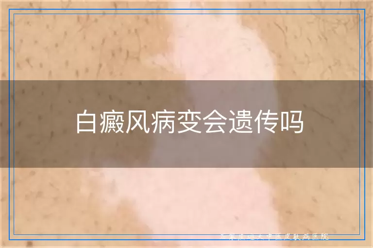 白癜风病变会遗传吗