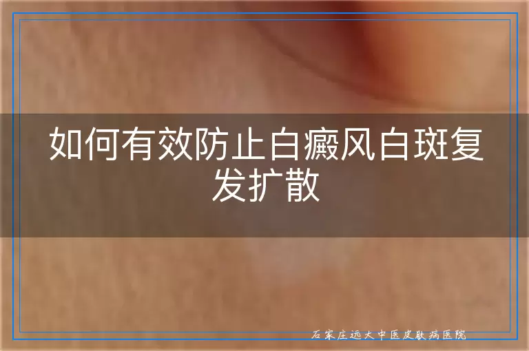 如何有效防止白癜风白斑复发扩散