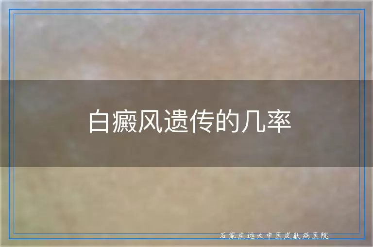 白癜风遗传的几率