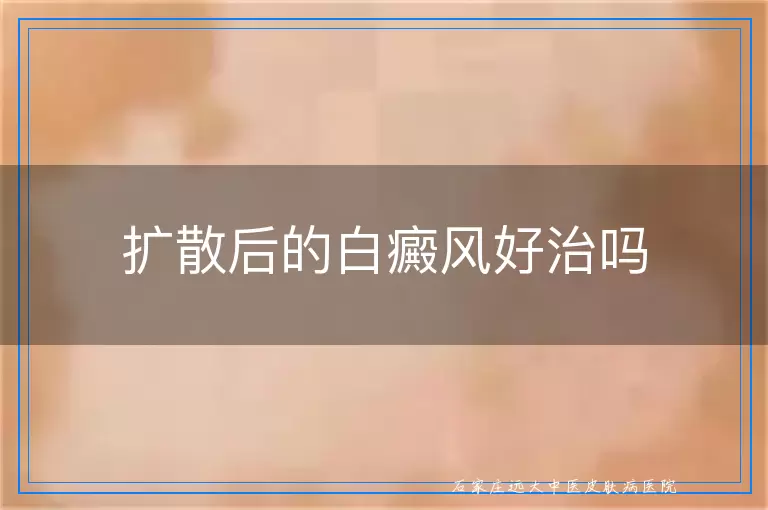 扩散后的白癜风好治吗