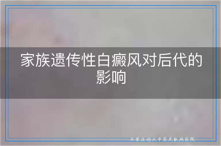 家族遗传性白癜风对后代的影响