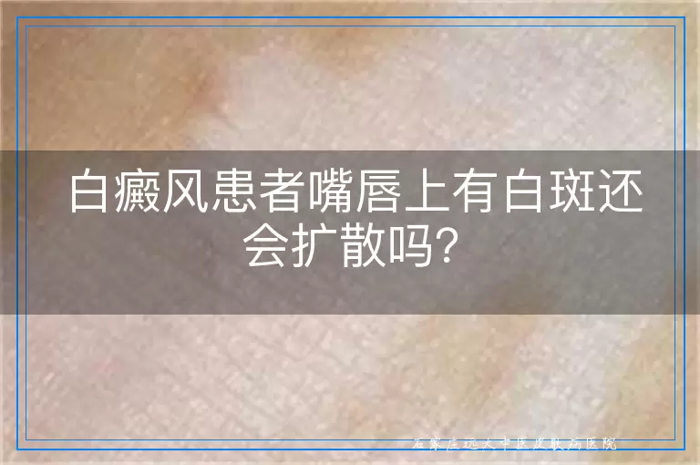 白癜风患者嘴唇上有白斑还会扩散吗？
