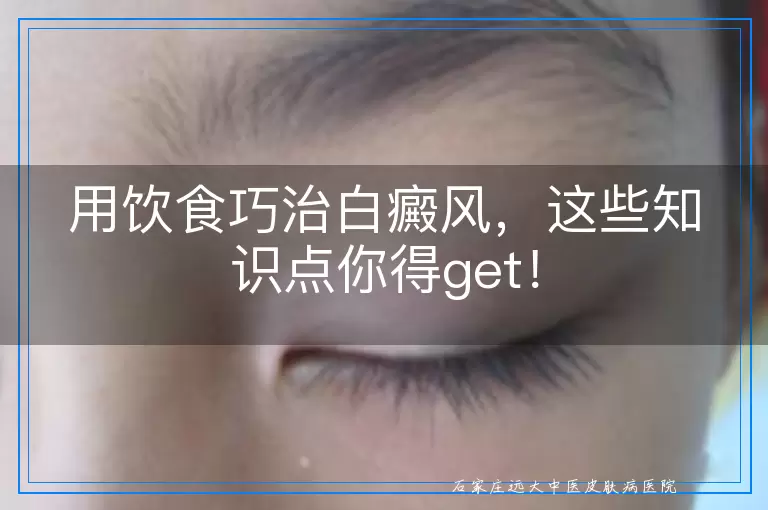 用饮食巧治白癜风，这些知识点你得get！