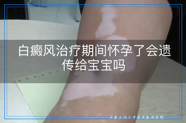 白癜风治疗期间怀孕了会遗传给宝宝吗