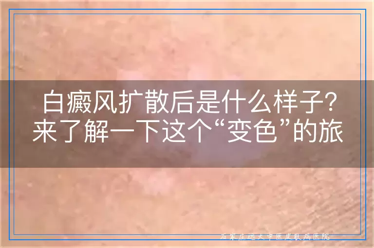 白癜风扩散后是什么样子？来了解一下这个“变色”的旅程