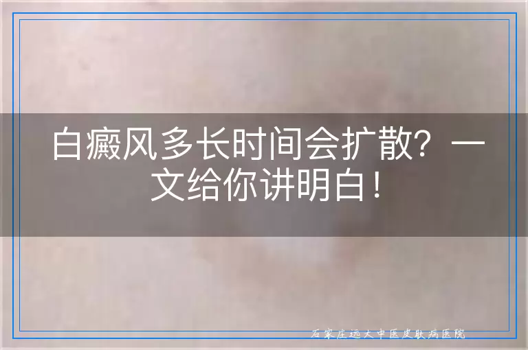 白癜风多长时间会扩散？一文给你讲明白！