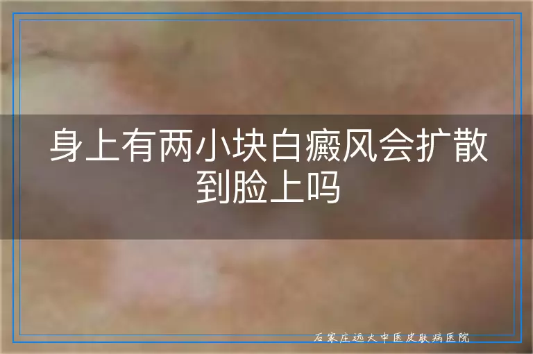 身上有两小块白癜风会扩散到脸上吗