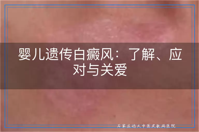 婴儿遗传白癜风：了解、应对与关爱