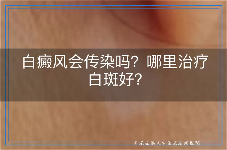 白癜风会传染吗？哪里治疗白斑好？