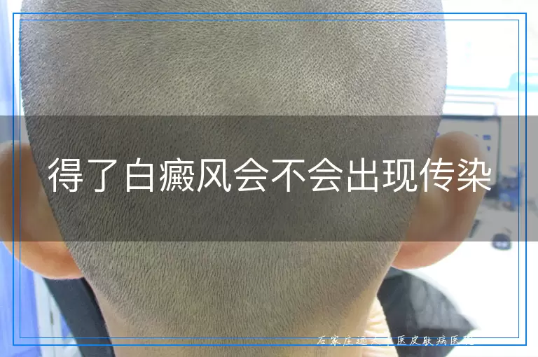 得了白癜风会不会出现传染