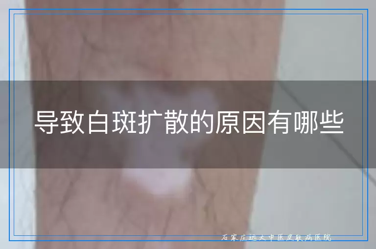 导致白斑扩散的原因有哪些