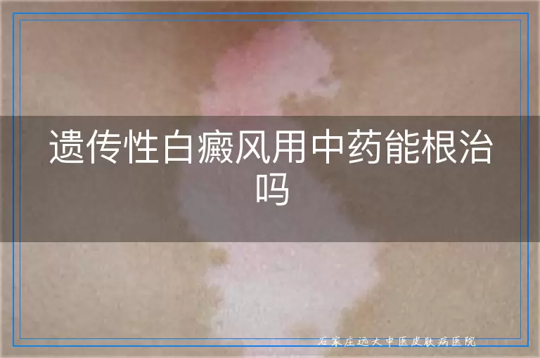 遗传性白癜风用中药能根治吗