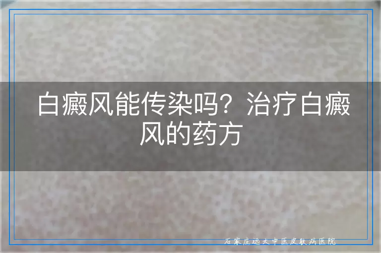 白癜风能传染吗？治疗白癜风的药方