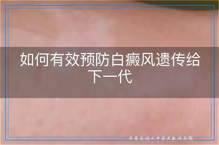 如何有效预防白癜风遗传给下一代