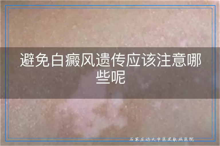 避免白癜风遗传应该注意哪些呢