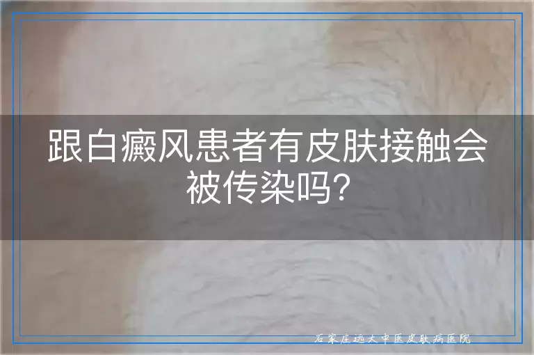 跟白癜风患者有皮肤接触会被传染吗？