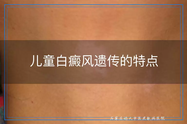 儿童白癜风遗传的特点