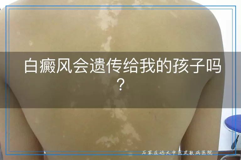 白癜风会遗传给我的孩子吗？