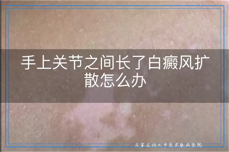 手上关节之间长了白癜风扩散怎么办