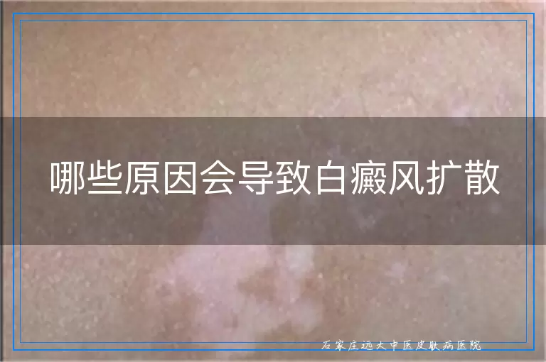 哪些原因会导致白癜风扩散