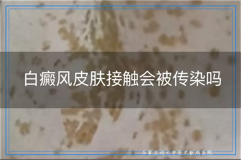 白癜风皮肤接触会被传染吗