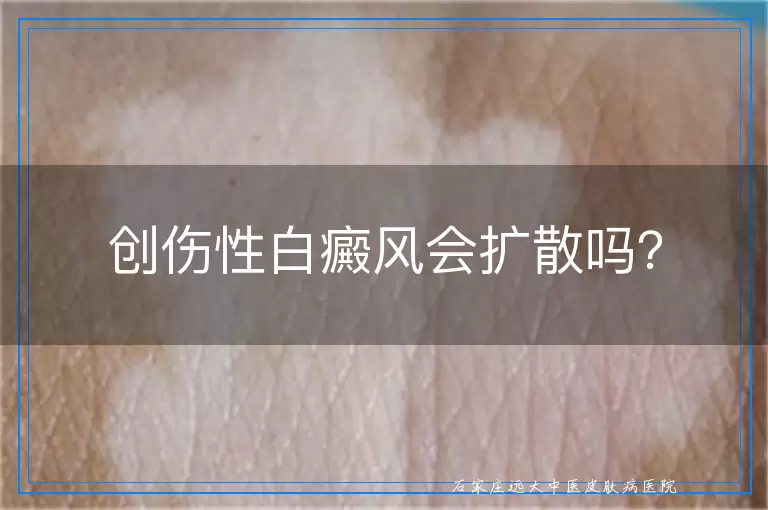 创伤性白癜风会扩散吗？