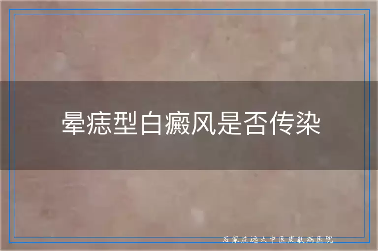 晕痣型白癜风是否传染