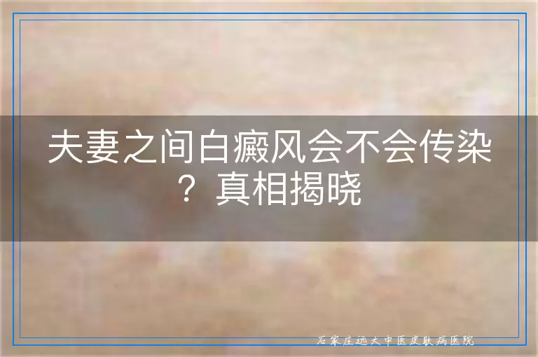 夫妻之间白癜风会不会传染？真相揭晓