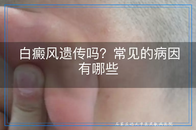 白癜风遗传吗？常见的病因有哪些