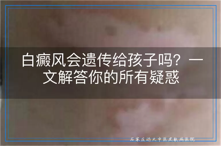 白癜风会遗传给孩子吗？一文解答你的所有疑惑