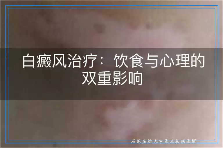 白癜风治疗：饮食与心理的双重影响