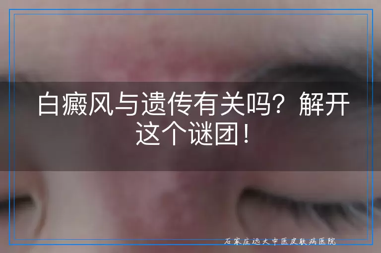 白癜风与遗传有关吗？解开这个谜团！