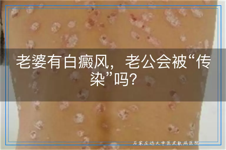 老婆有白癜风，老公会被“传染”吗？