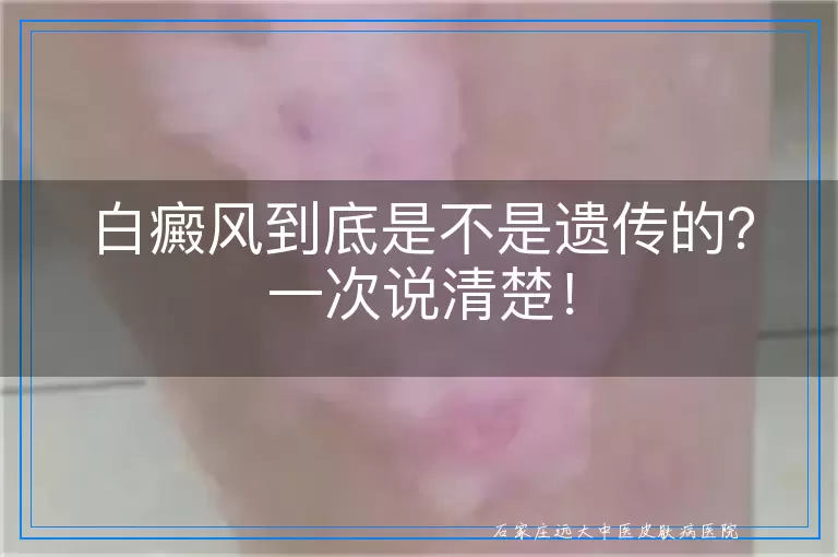 白癜风到底是不是遗传的？一次说清楚！