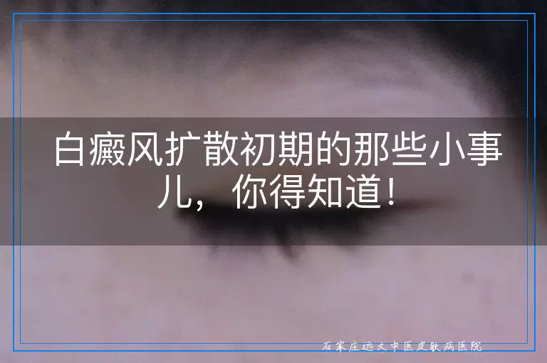 白癜风扩散初期的那些小事儿，你得知道！