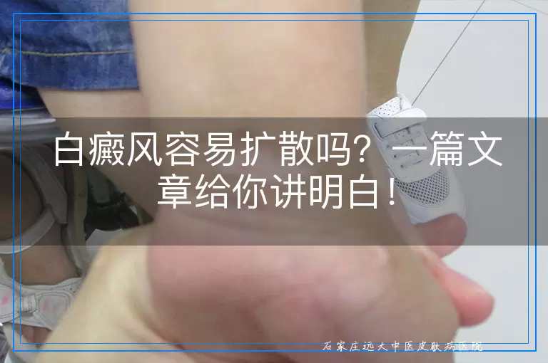 白癜风容易扩散吗？一篇文章给你讲明白！