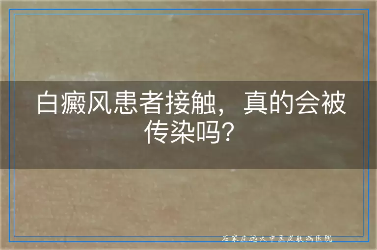 白癜风患者接触，真的会被传染吗？