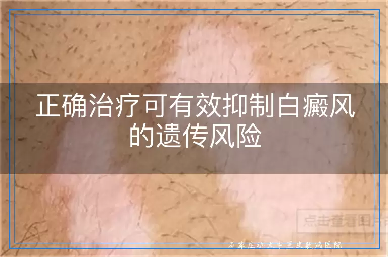正确治疗可有效抑制白癜风的遗传风险