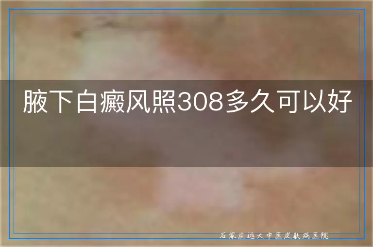 腋下白癜风照308多久可以好