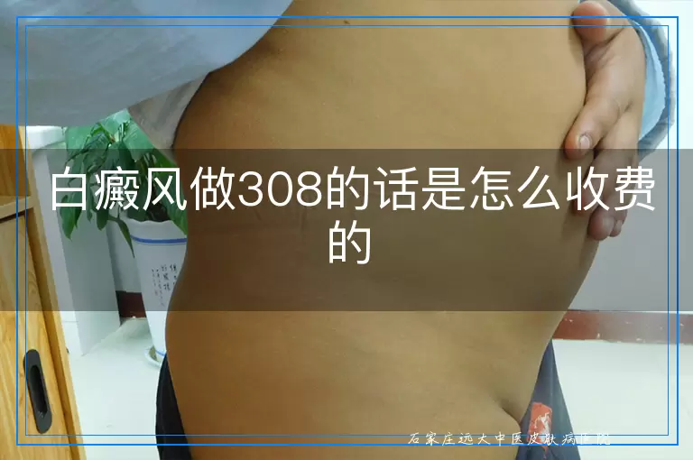 白癜风做308的话是怎么收费的