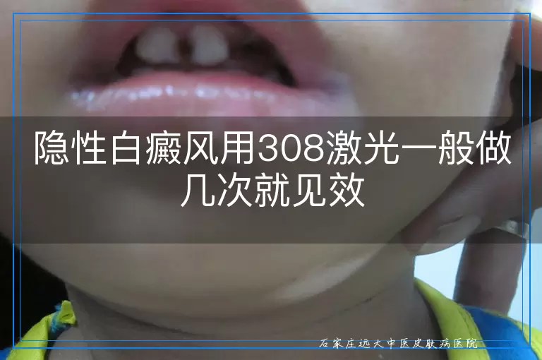 隐性白癜风用308激光一般做几次就见效