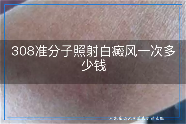 308准分子照射白癜风一次多少钱